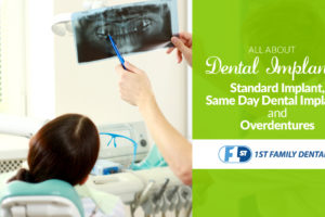 All About Dental Implants: Standard Implant, Same Day Dental Implants, and Overdentures