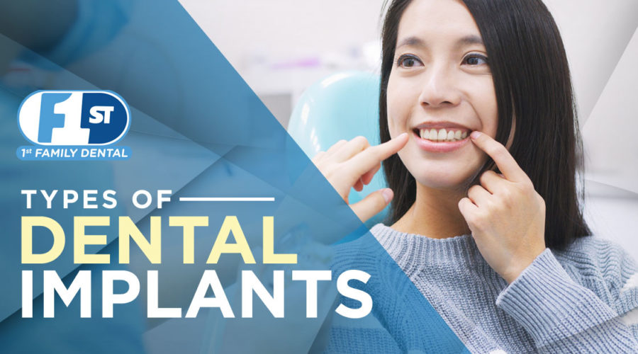 Type of Dental Implants - 1st Family Dental, IL