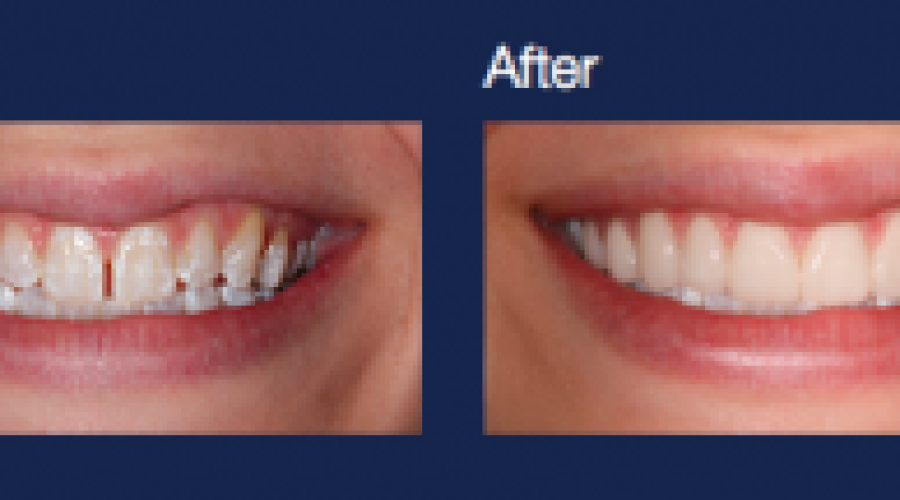 Before & After Teeth Cleaning