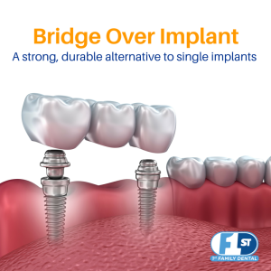 bridge over implant - affordable tooth replacement options