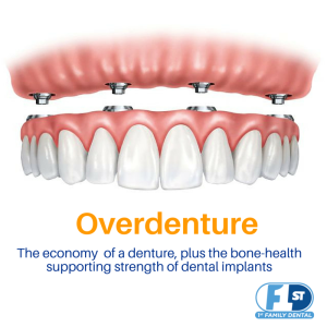 overdentures - affordable tooth replacement options