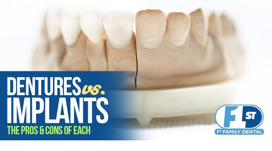 Dentures vs Implants: Pros and Cons