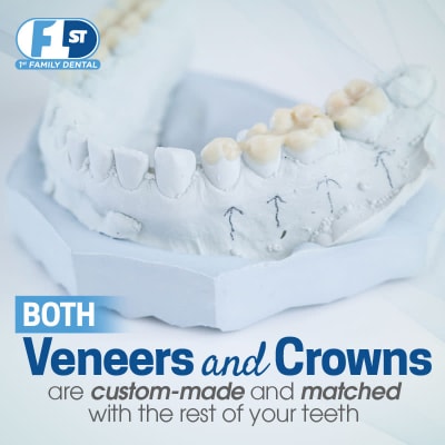 1FD Crowns or Veneers custom-made 400x400-min