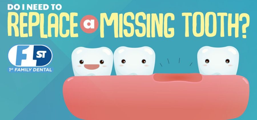 1FD Blog - Do I need to replace a missing tooth