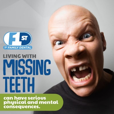 1FD Blog -Missing Teeth Internal Image