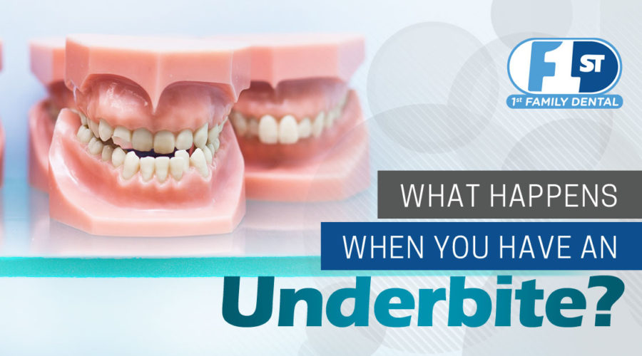 What Happens When You Have an Underbite? Chicago Family Dentistry