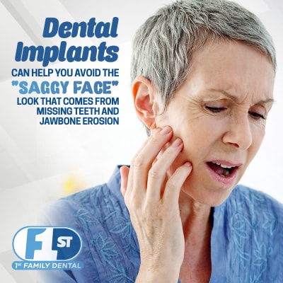 Dental Implants - Avoid Saggy Face