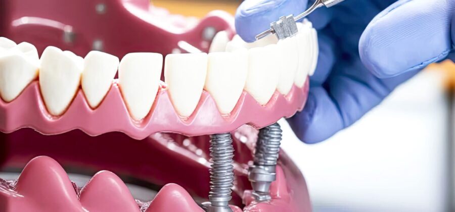a dentist playing a full mouth dental implant model onto model implant posts.