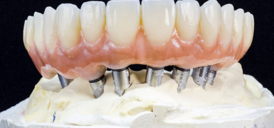 Medically accurate 3D illustration of human teeth and Implant concept