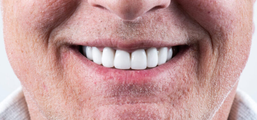 an all on x full mouth dental implant patient smiling.