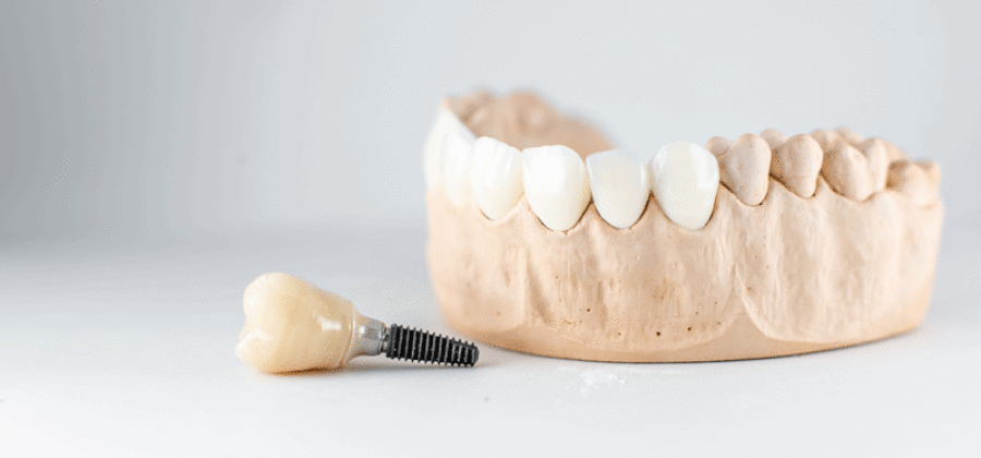 Dental implant in front of lower mouth model