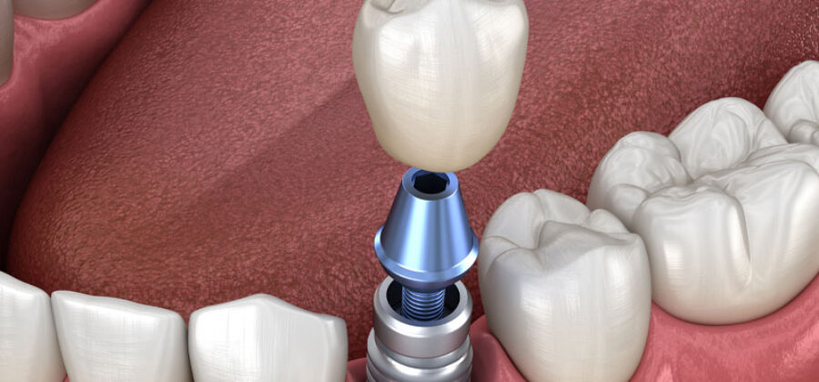 dental implant model.