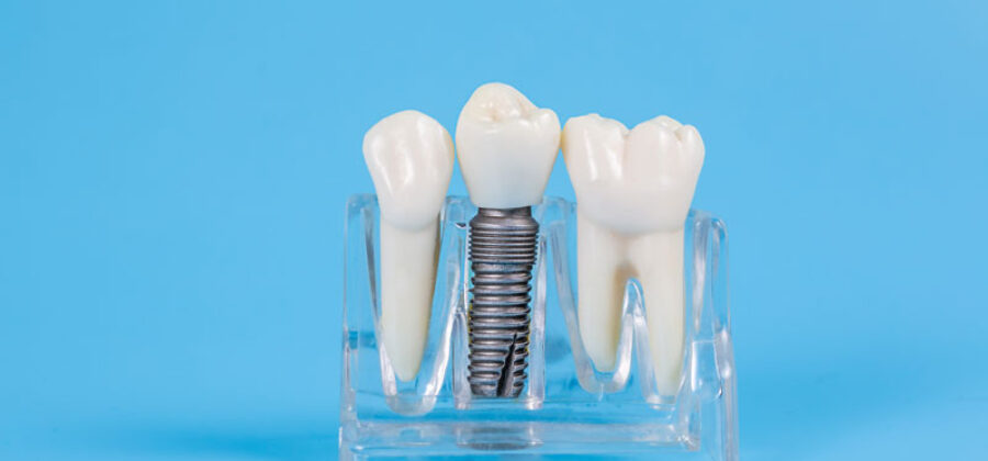 an image of a single dental implant.