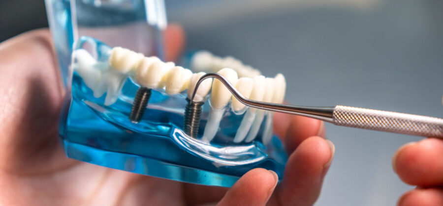 close-up of a dental implant model being held by a hand. The model shows a clear plastic jaw with a set of white teeth. One of the teeth has a metal dental implant installed in it, and a tool, likely a dental explorer or probe, is being used to point at or manipulate the implant.